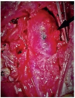 Invasión tumoral
por el glomus sin plano de clivaje