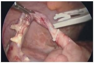 Ligadura de base apendicular en laparoscopia por multipuerto.