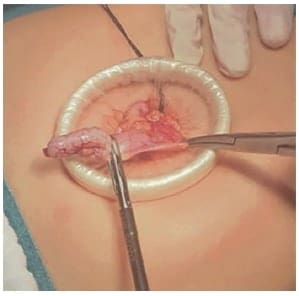 Ligadura de base apendicular en laparoscopia transumbilical asistida.