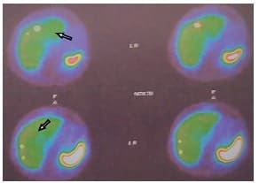 Lesiones hipercaptantes por las metástasis hepáticas.