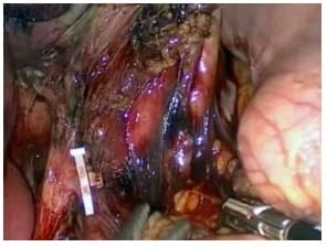 Linfadenectomía de la arteria gástrica izquierda