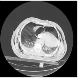 Bilateral pneumothorax, cardiac herniation 