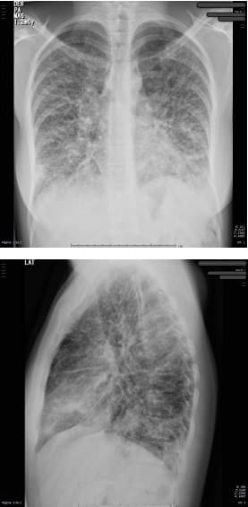 Proyección AP y lateral con opacidades reticulares bilaterales 