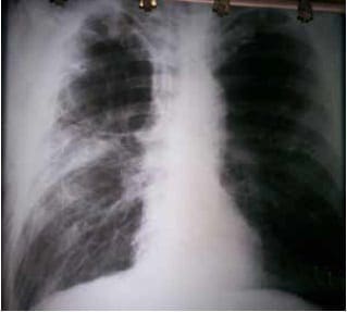 Reexpansión del pulmón
derecho