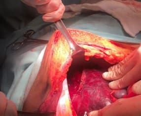 Laparotomía donde se aprecia la ruptura hepática del lóbulo derecho