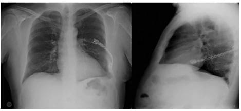 Radiografía de tórax normal al segundo año de control posoperatorio