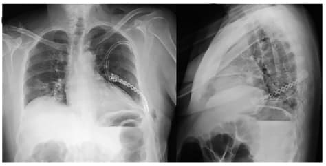 Radiografía anteroposterior y lateral de tórax al primer día postoperatorio