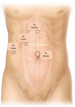 Posición de los trocares para colecistectomía
laparoscópica