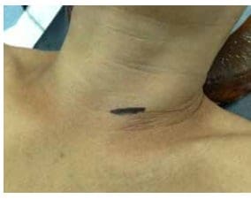 Abordaje quirúrgico por vía retro-tiroidea izquierda