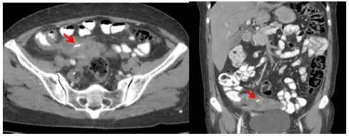 Tomografia computarizada de abdomen con contraste, la flecha señala el cuerpo extraño