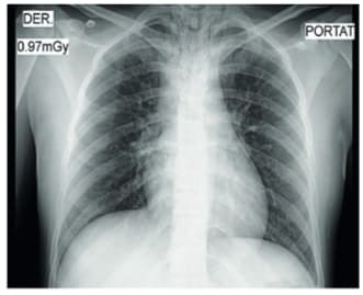  Radiografía anteroposterior de tórax observando una adecuada expansión pulmonar