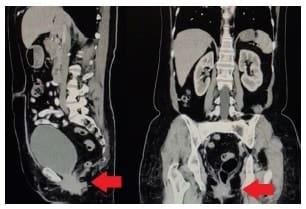 Hernia, cortes sagital
y coronal.