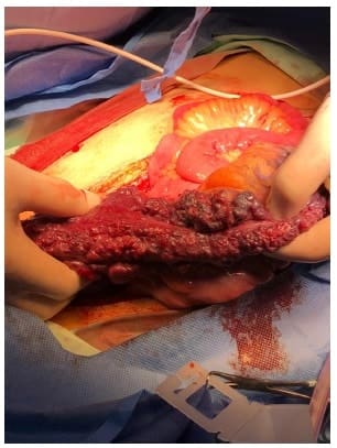 Dilataciones vasculares en colon sigmoides