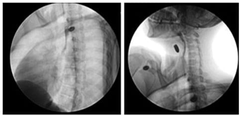 Esofagograma con contraste oral hidrosoluble