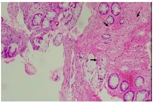 Mucosa colorrectal, fibrosis (flechas), sin evidencia de lesión residual