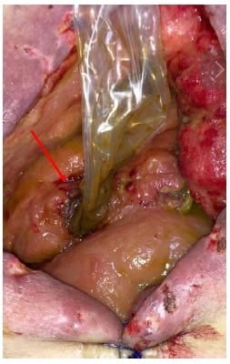 Fístula de intestino delgado