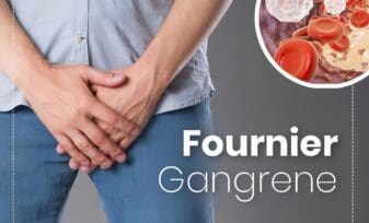 Gangrena de Fournier