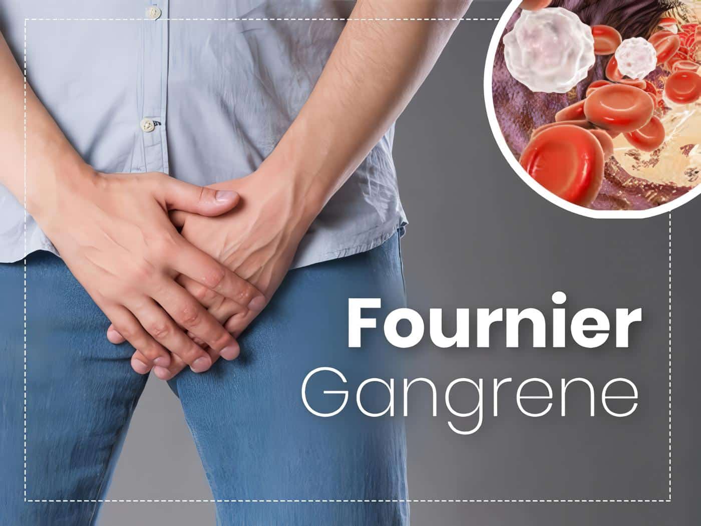 Gangrena de Fournier