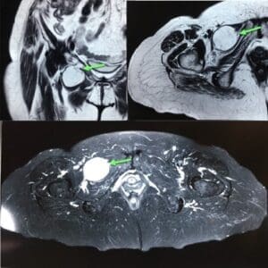 Hernia Obturatriz | Obstrucción Intestinal | Dolor Pélvico | Cirugía