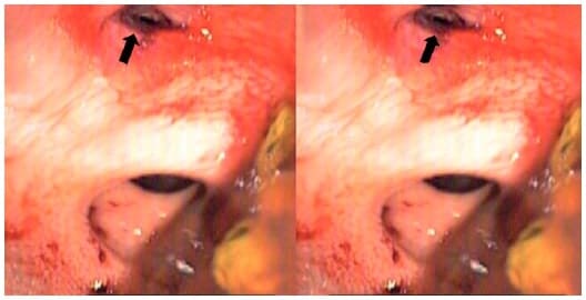 Lesión traumática con bordes necróticos, irregulares