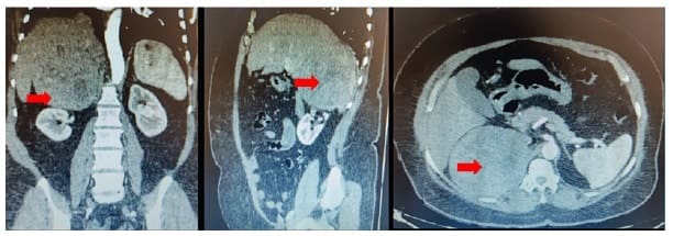 Lesión tumoral en la glándula suprarrenal derecha - Feocromocitoma Adrenal Gigante Derecho