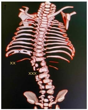Tomografía computarizada de columna donde
se observa fusión de costillas