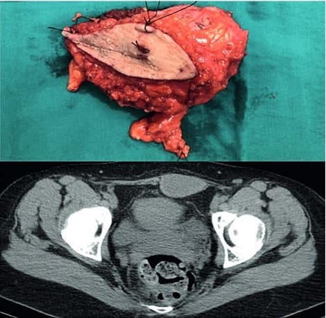 Masa  resecada,  en  la  parte  inferior - Fibromatosis Agresiva