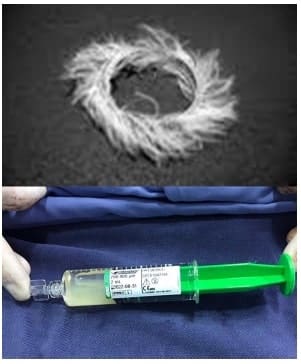 Elementos de embolización con micropartículas y microcoils - Manejo de Placenta Percreta con Cesárea