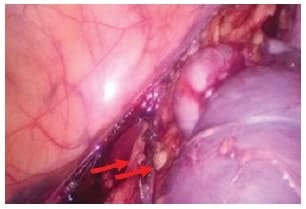 Imágenes nodulares compatibles con ganglios linfáticos