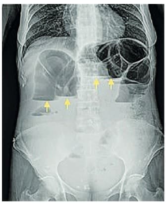 Radiografía de abdomen simple con signos de obstrucción intestinal