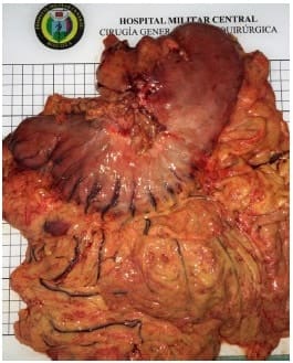Pieza quirúrgica de gastrectomía total - Metástasis Ganglionares en Cáncer Gástrico