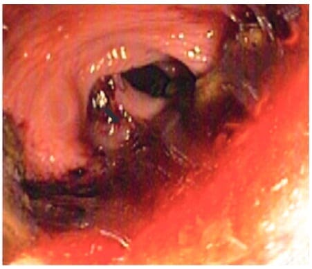 Rectosigmoidoscopia intraoperatoria