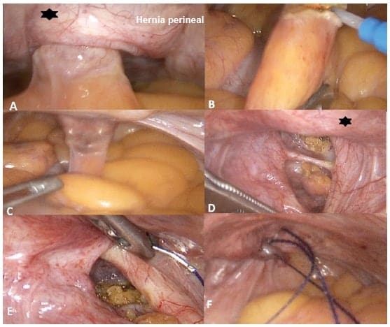 Reparo laparoscópico de la hernia perineal