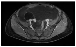 Resonancia magnética abdominal corte axial - Quistes Mesoteliales Benignos