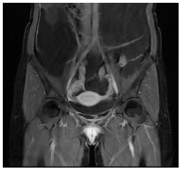 Resonancia magnética abdominal corte coronal - Quistes Mesoteliales Benignos