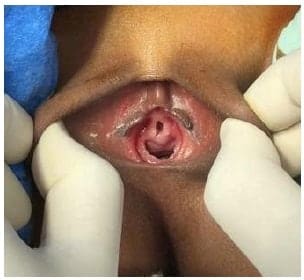 Tracción de los labios mayores donde se aprecia protrusión de mucosa - Ubicación de suturas de reparo - Prolapso Uretral