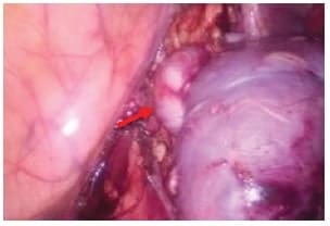 Tumor ubicado en el polo superior del riñón derecho
