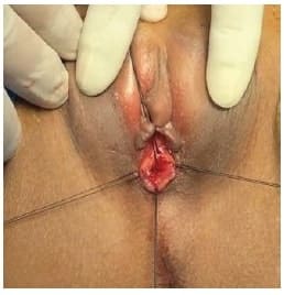 Ubicación de suturas de reparo - Prolapso Uretral