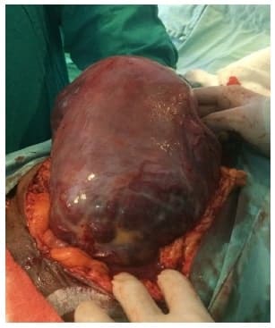 vasos sanguíneos fuera de la serosa uterina, típico de placenta percreta