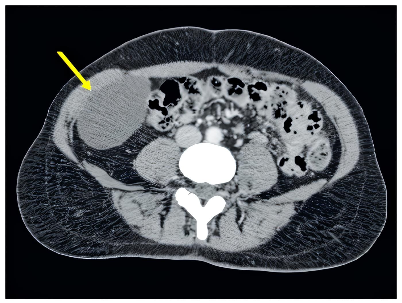 Abdomen donde se
aprecia una lesión quística