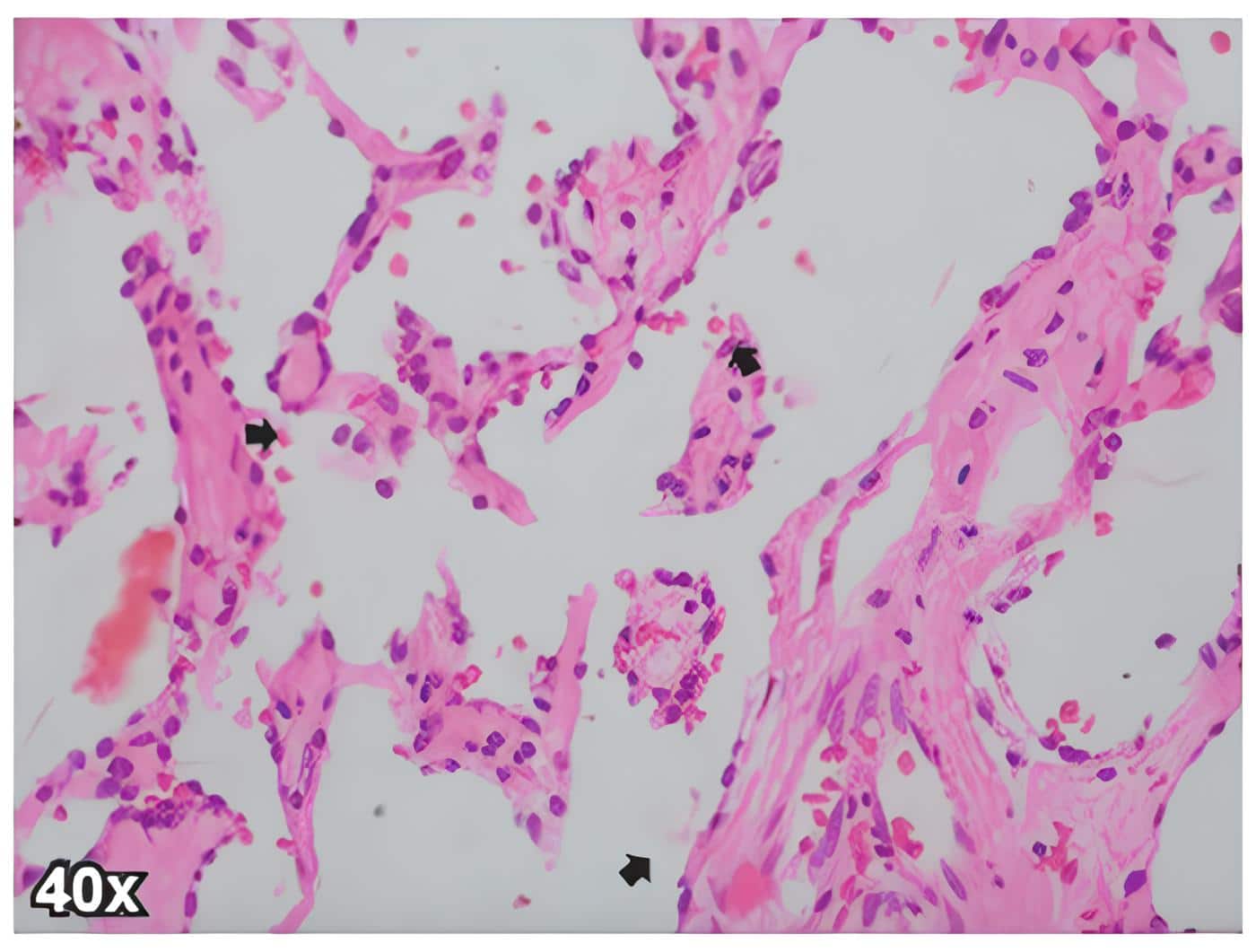 Angiosarcoma de mama de la
paciente, donde se observan celulas endoteliales