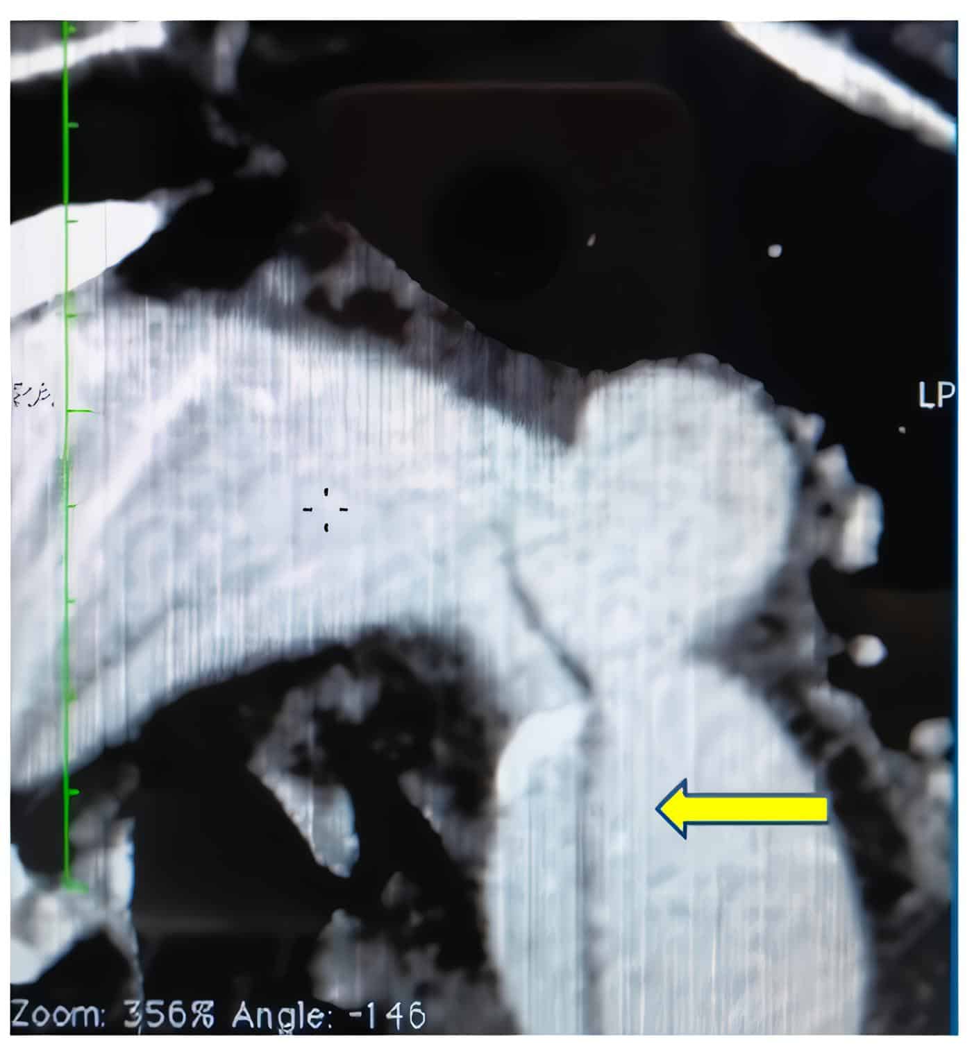 Angiotac con úlcera aortica y disección