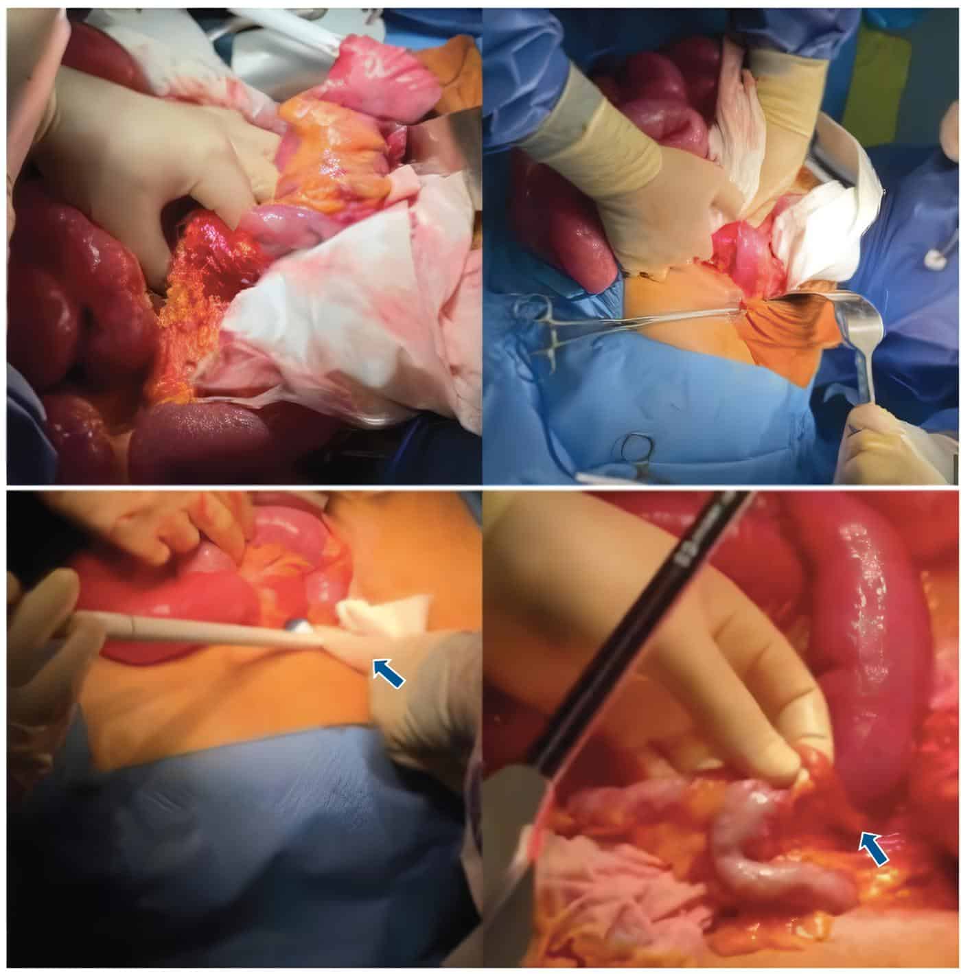 Apendicectomía, cecostomía aspirativa a través de base apendicular
