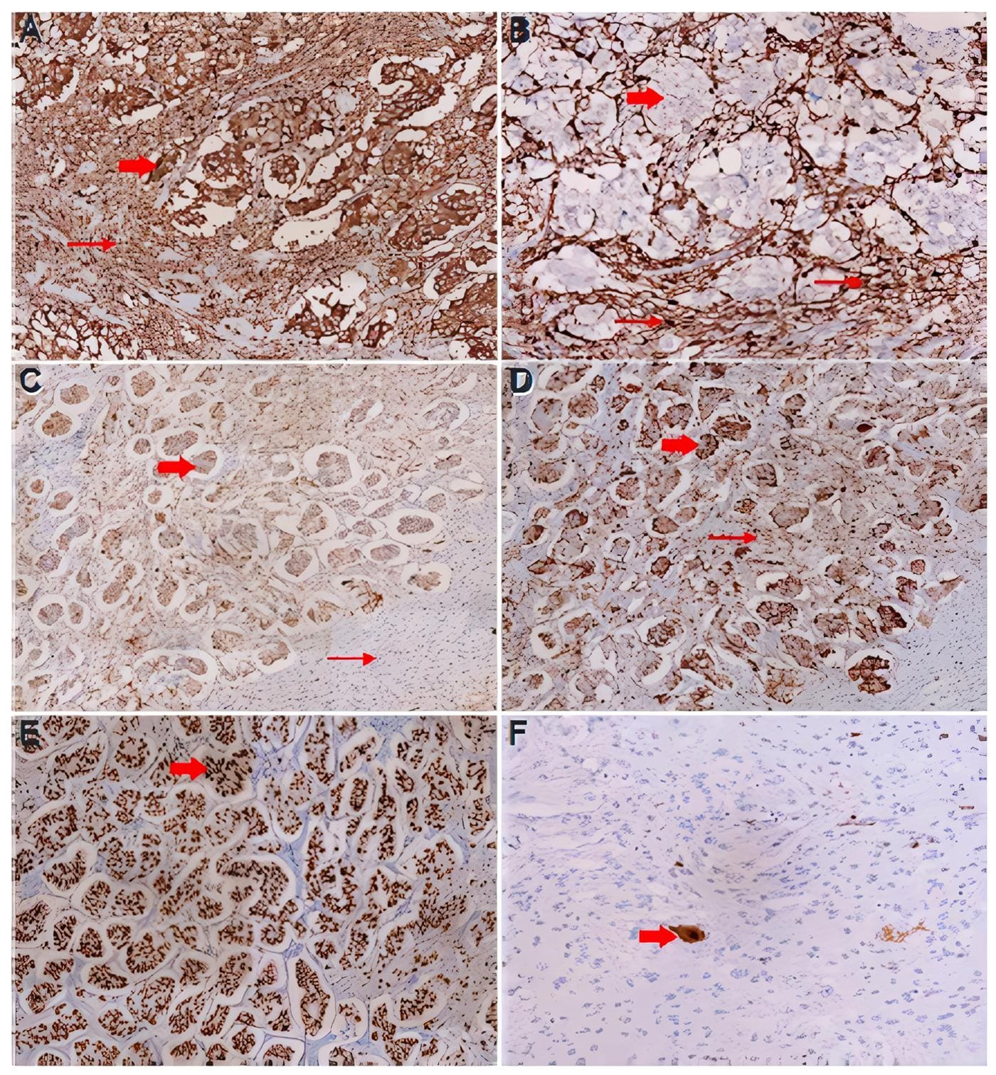 Inmunohistoquímica con sinaptofisina, positiva en el componente de células epitelioides - Paraganglioma Gangliocítico Metastásico