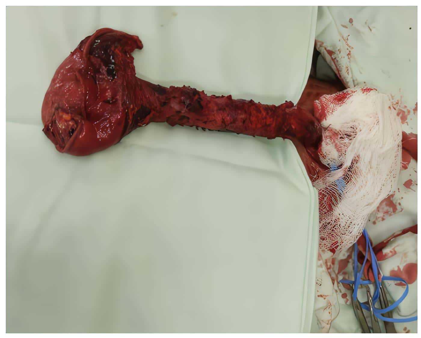Reemplazo Esofágico Mínimamente Invasivo - Extracción del esófago y segmento gástrico vía transcervical