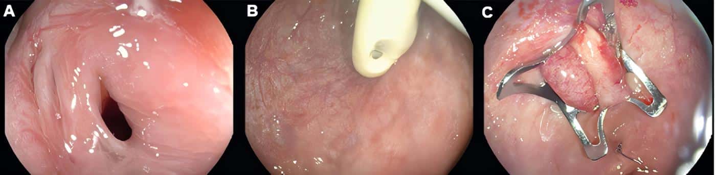 Fistula rectovesical - Tracto Gastrointestinal con Clip sobre el Endoscopio