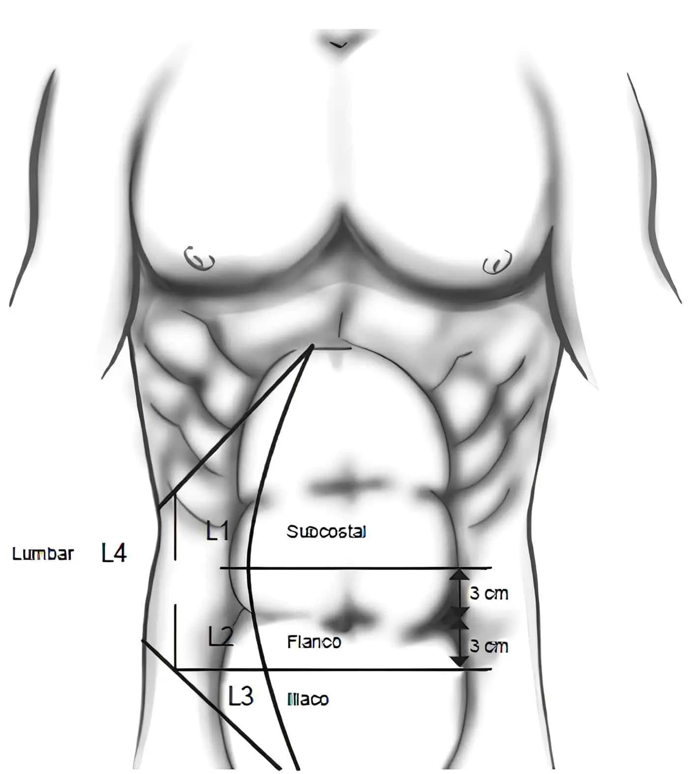 Clasificación de la distribución anatómica de las hernias laterales según la European Hernia Society