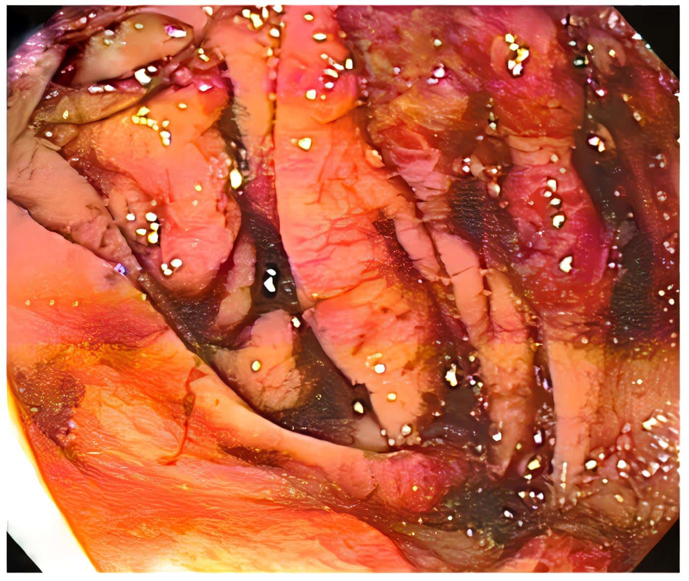 Lesiones por angiosarcoma en colon con sangrado reciente que obstruye la correcta visualización