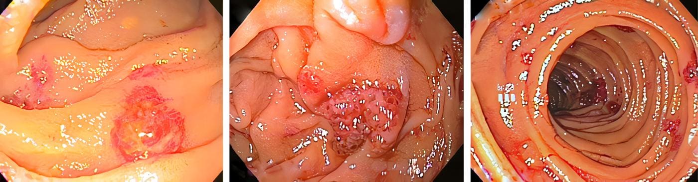 Lesiones por angiosarcoma en intestino delgado