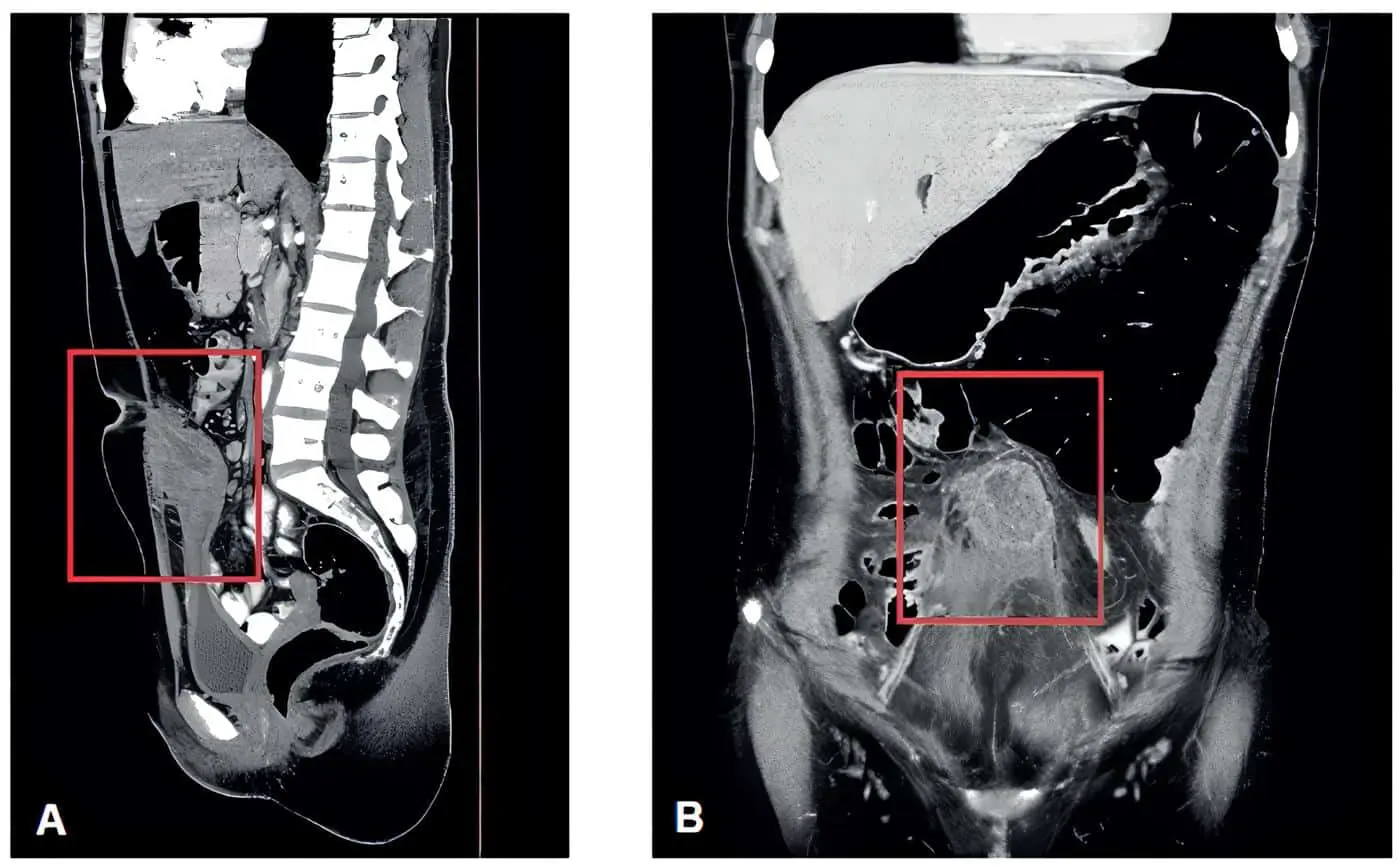 Masa intraperitoneal extendiéndose desde la región umbilical y hasta la pared superior